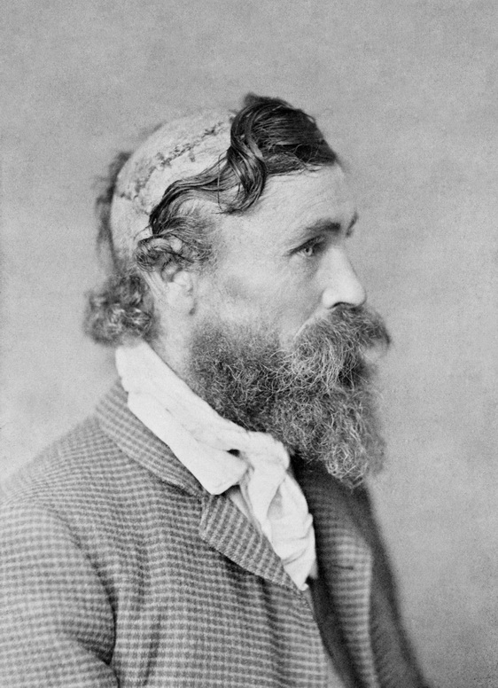 Robert_McGee,_scalped_as_a_child_by_Sioux_Chief_Little_Turtle_in_1864-2.jpg